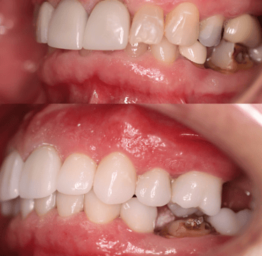 Full Mouth Rehabilitation