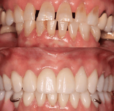 Full Mouth Rehabilitation