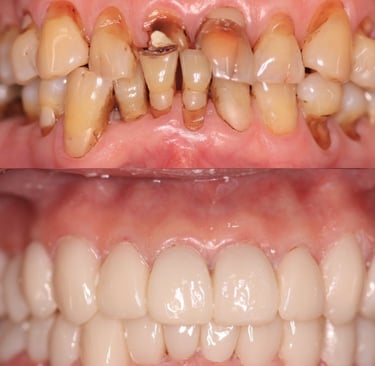 Full Mouth Rehabilitation