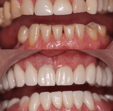 Full Mouth Rehabilitation