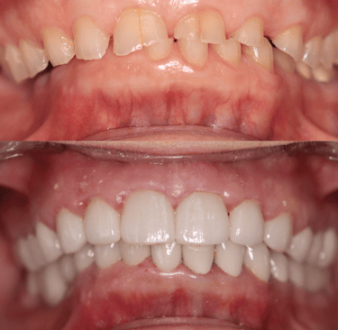 Full Smile Makeover before and after