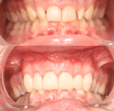 Full Mouth Rehabilitation