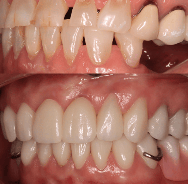 Full Mouth Rehabilitation