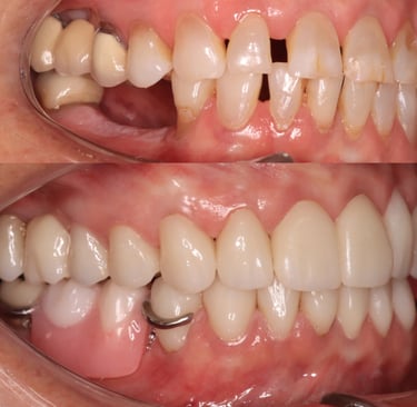 Full Mouth Rehabilitation