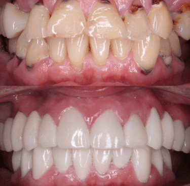 Full Mouth Rehabilitation