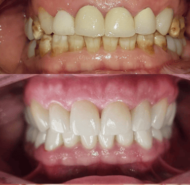 Full Mouth Rehabilitation