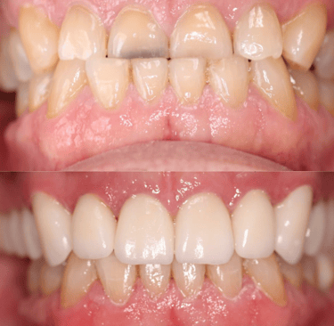 Upper zirconium Crowns