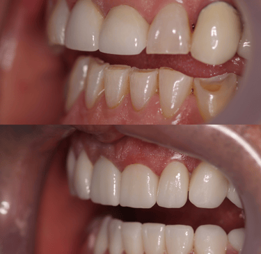 Side view of a before and after full zirconium crowns