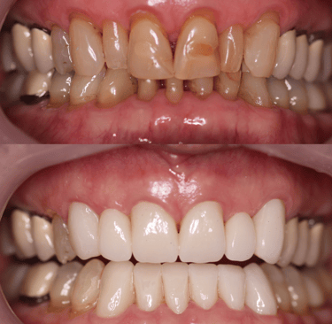 Before and after 12 zirconium crowns
