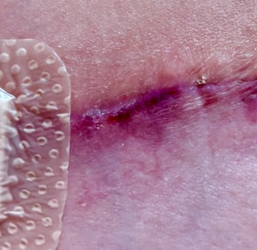 Red inflamed scar after DIEP surgery