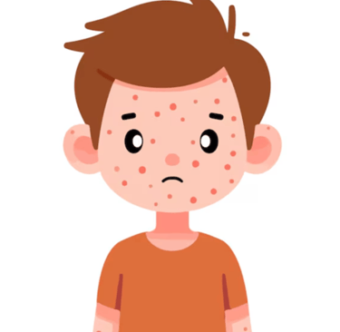 niño con brote de sarampión