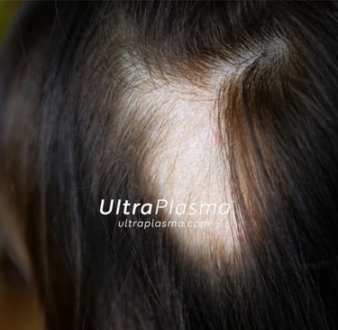 ultraplasma.com_alopecia_treatment_alopesi_tedavisi_ultra_plasma_ultra_plazma