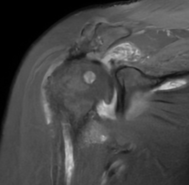 Hombro con lesión masiva de mango rotador por resonancia magnética.