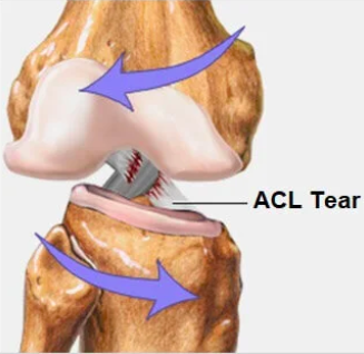 Mecanismo de lesión del ligamento cruzado anterior