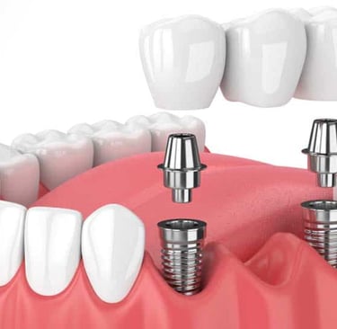 best dental implant specialist in baner