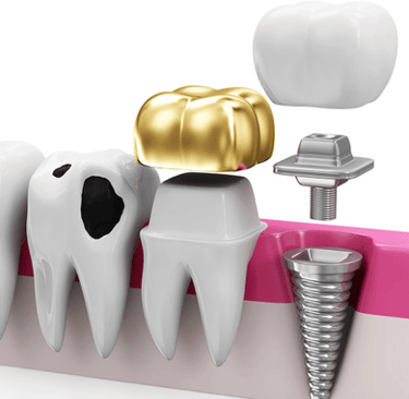 restorative dental procedures