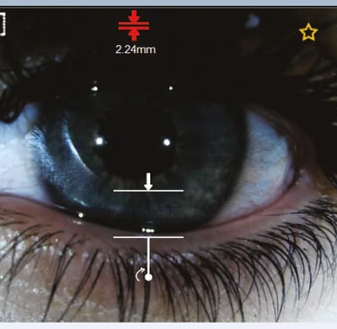 Evaluación lágrima