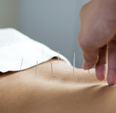 Close-up of acupuncture needles placed on woman's lower back for fertility
