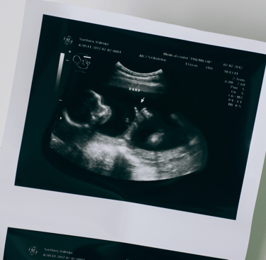 Printed ultrasound image of an IVF pregnancy scan on white surface
