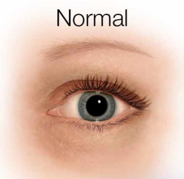 Normal human eye with clear lens vs eye with cataract.