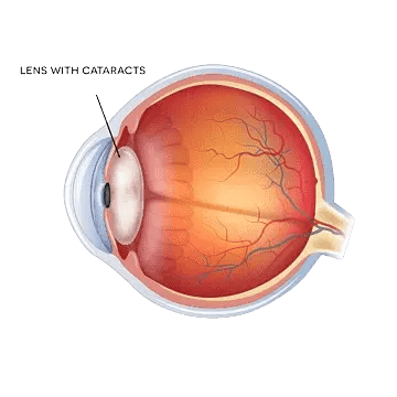 image of eye anatomy diagram showing cataractous lens