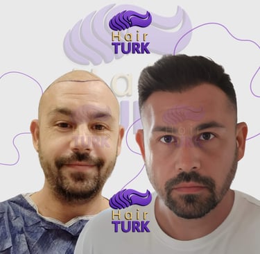 Before/after hair transplant DHI – male patient, 3500 grafts