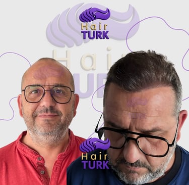 Patient result 12 months after a 4200 graft FUE hair transplant
