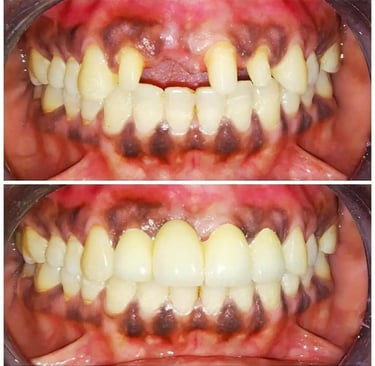Metal Free Zirconia Crowns and Bridges Before After