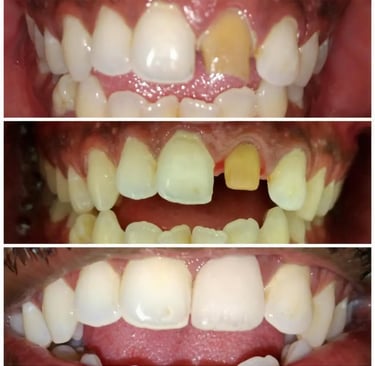 Digital Smile Design Makeover Process