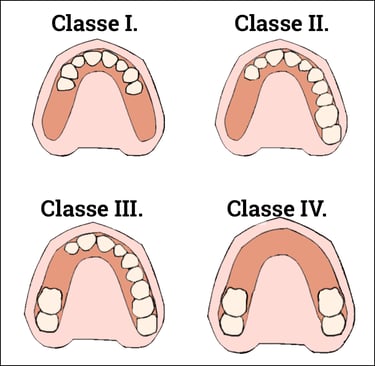 classificação de kennedy resumo classe i, classe ii, classe iii, classe iv