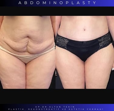 tummy tuck before after photos