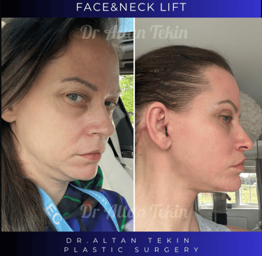 face lift before after pictures