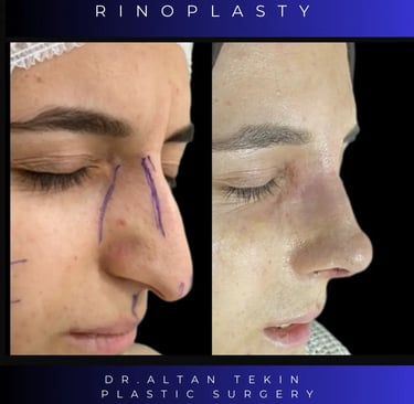 rhinoplasty before after photos in Antalya, Turkey