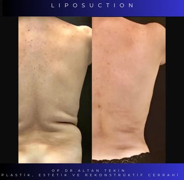 liposuction before after photos, Antalya
