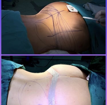 buttock lift before after photos in Antalya