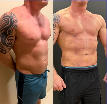 Before and after photos showing defined abdominal etching results on a patient.
