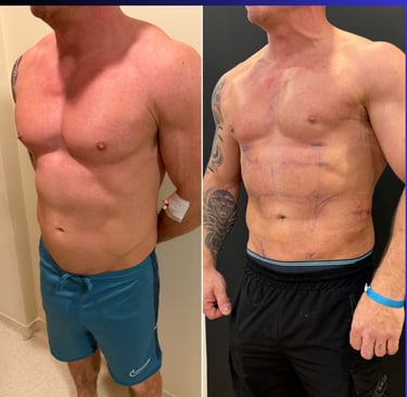 Before and after photos showing defined abdominal etching results on a patient.