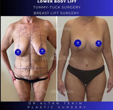 mommy makeover before after photos in Antalya, Türkiye