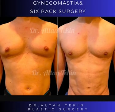 gynecomastia before after photos in Antalya, Turkey.