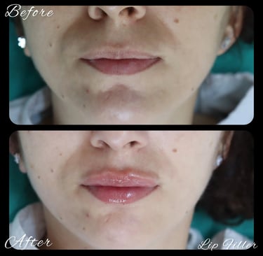 lip filler before after photos in Antalya