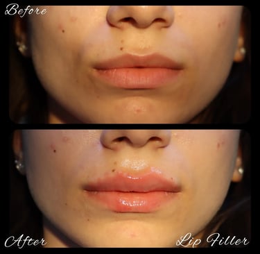 lip filler before after photos in Antalya