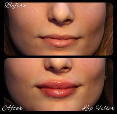 lip filler before after photos in Antalya