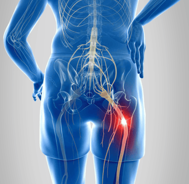 sciatique etiopathie