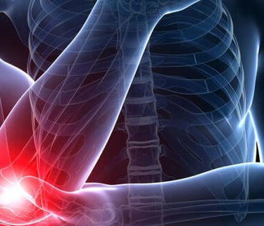 épicondylite etiopathie