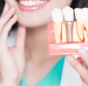 Best Dental Implants in Vashi, Ghansoli | kopar khairane Navi Mumbai, India, Near me