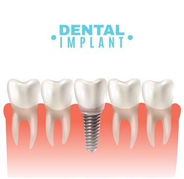 Best Dental Implants Clinic near me | Ekdantam Dental Clinic