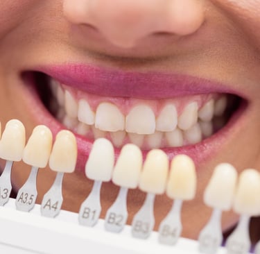 Teeth Whitening by Ekdantam Dental Clinic Navi Mumbai