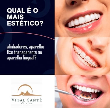 Aparelho dentário estético - invisível, fixo transparente e aparelho lingual