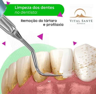 remoção de tártaro recreio