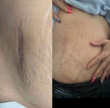 Scalp Micropigmentation in Toronto_ATRUBARBER Scalp Micropigmentation Studio